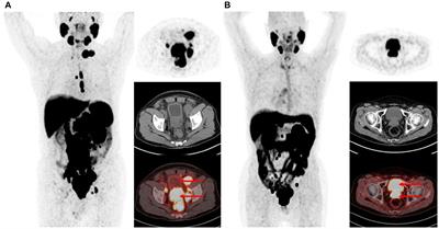 An exploratory study of unexplained concentration of 18F-PSMA-1007 in the bladder for prostate cancer PET/CT imaging